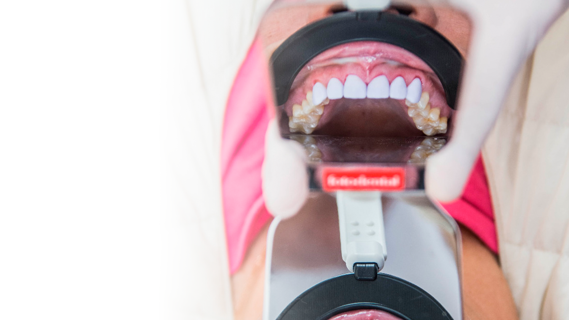 Comparación de carillas de porcelana recién colocadas con los dientes naturales