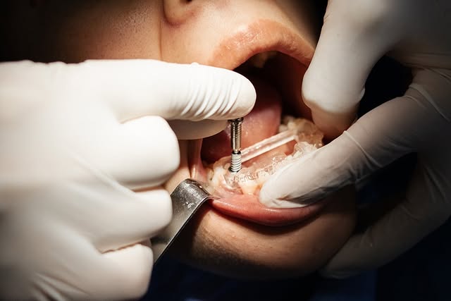 Colocación de un implante dental